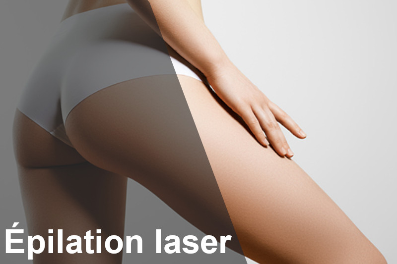 QUELS SONT LES SECRETS D’UNE ÉPILATION LASER RÉUSSIE ?