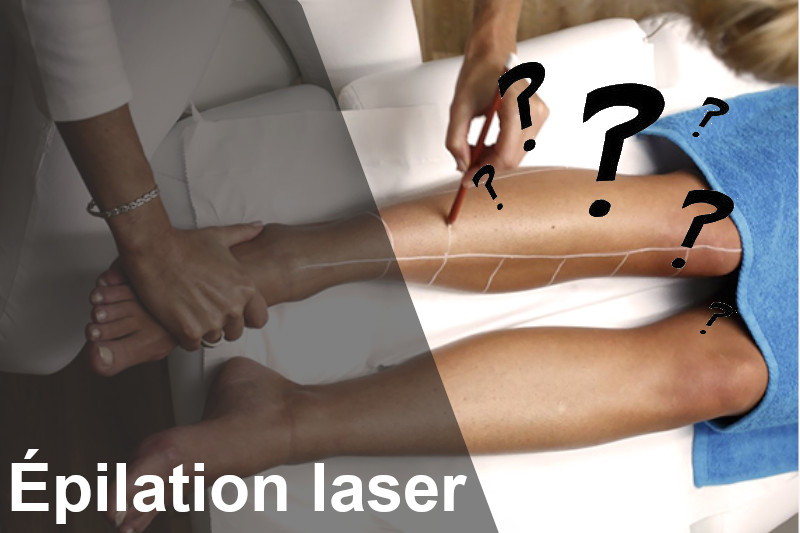 EPILATION LASER : TOUT SAVOIR SUR L’ÉPILATION LASER